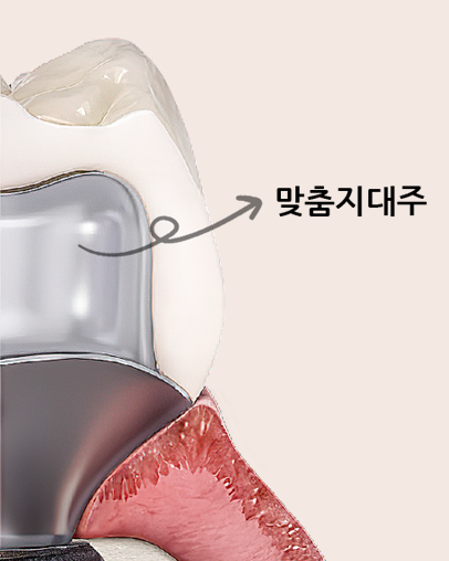 커스텀 어버트먼트