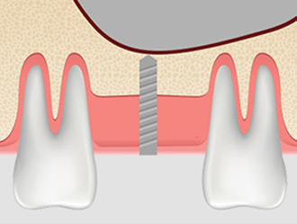 치조정접근법 순서1