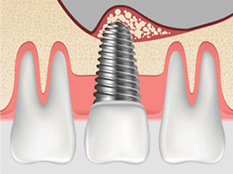 치조정접근법 순서4