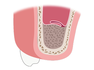 외측 접근법 순서3