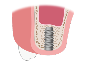 외측 접근법 순서4