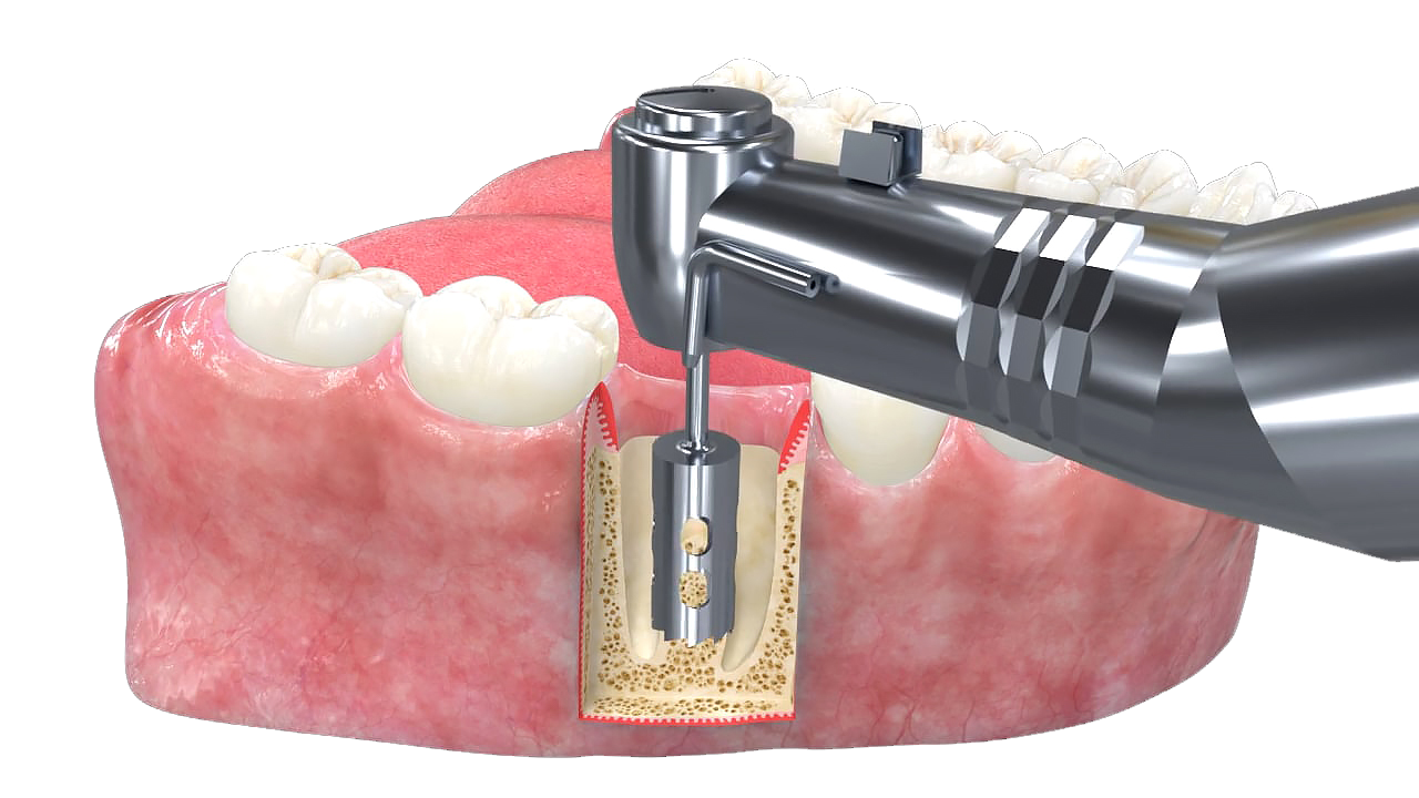 원데이 임플란트
