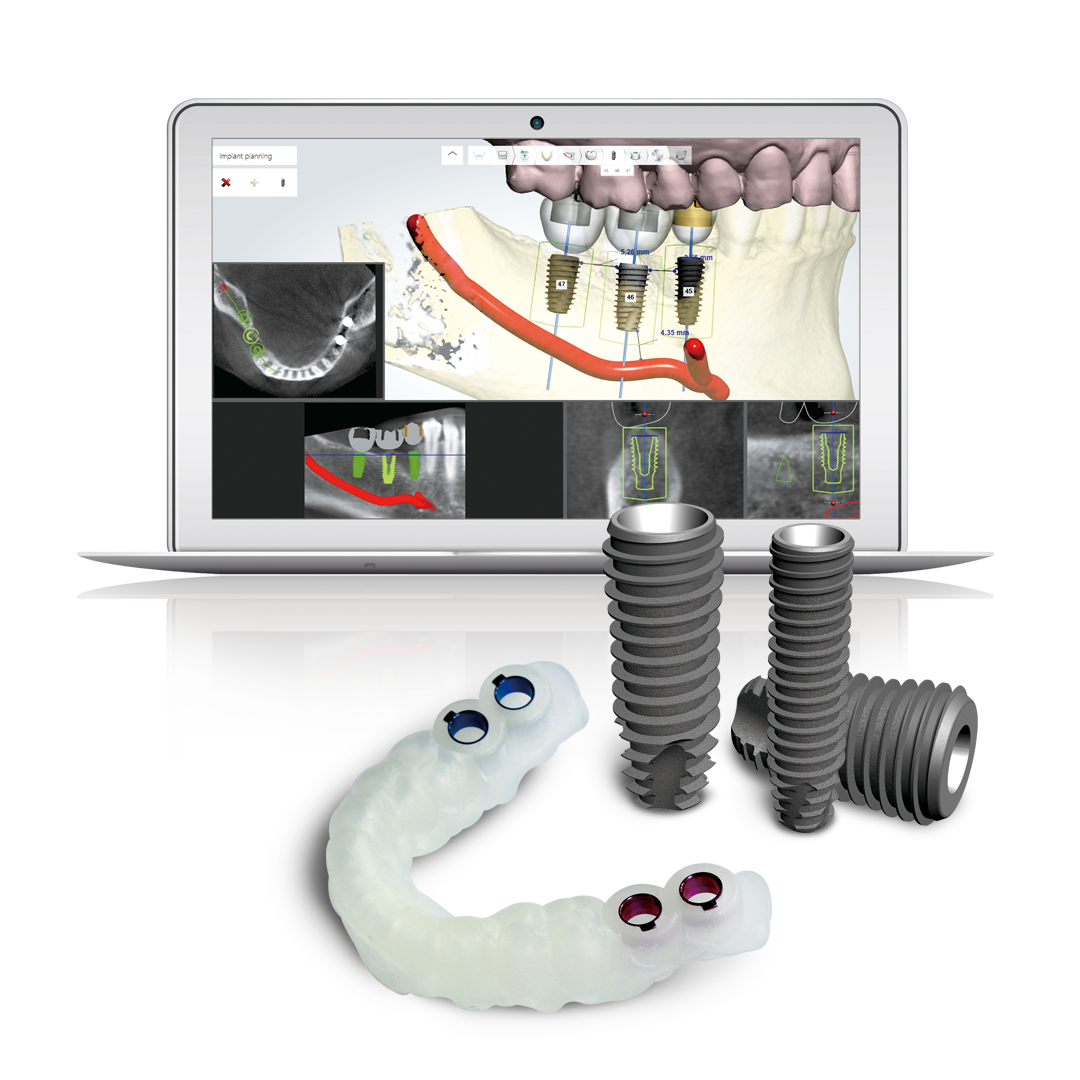 디지털 임플란트
