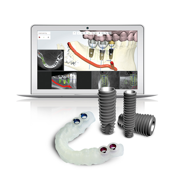 디지털 임플란트