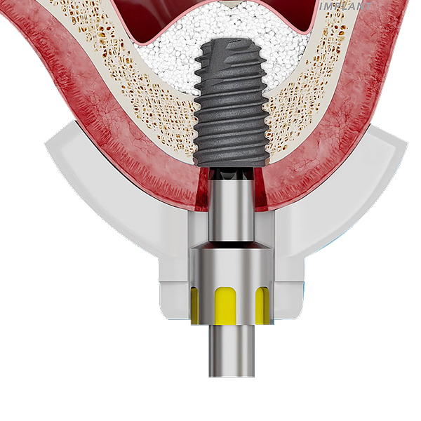 고난이도 임플란트