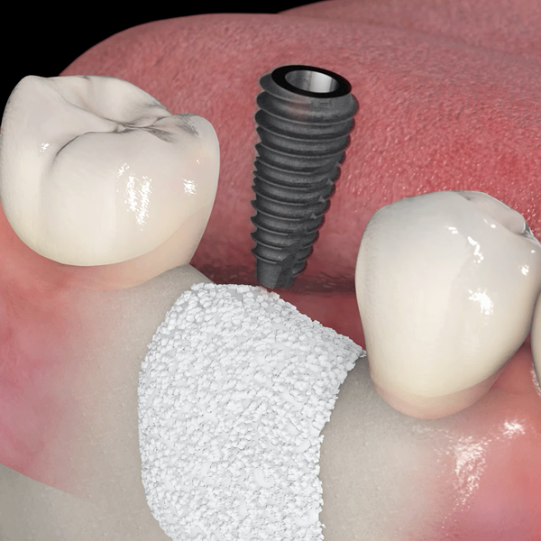 뼈이식 임플란트